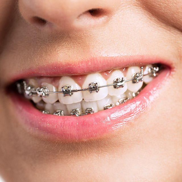 Tratamientos de ortodoncia